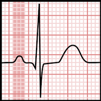 Low Cost Model EKG Machine