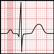 Low Cost Model EKG Machine